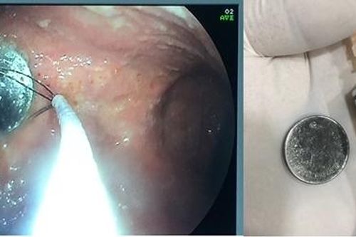 Đồng xu đường kính 2cm trong dạ dày bé gái 4 tuổi