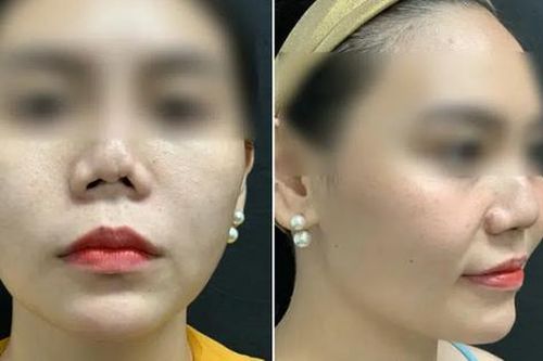 BS thẩm mỹ chia sẻ về ca khó nhất trong gần 20 năm làm nghề: Cứu chiếc mũi bị thẩm mỹ hỏng 8 lần đến mức biến dạng của cô gái trẻ