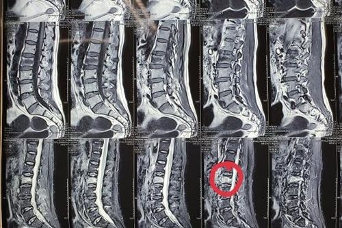 Điều trị hiệu quả xẹp đốt sống bằng phương pháp hiện đại