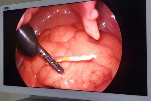 Điều trị thành công xương cá đâm thủng ruột non
