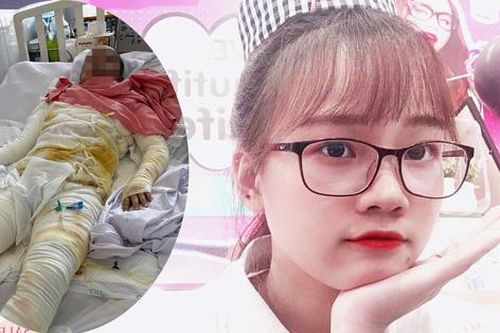 Cô gái bị bỏng toàn thân, người yêu qua đời: Dự định sang năm đám cưới mãi tiêu tan