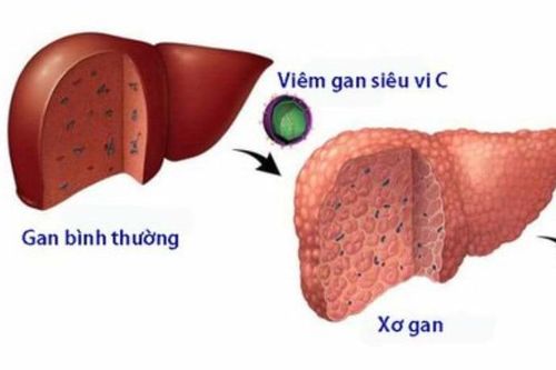 Cách chặn viêm gan C không thành ung thư