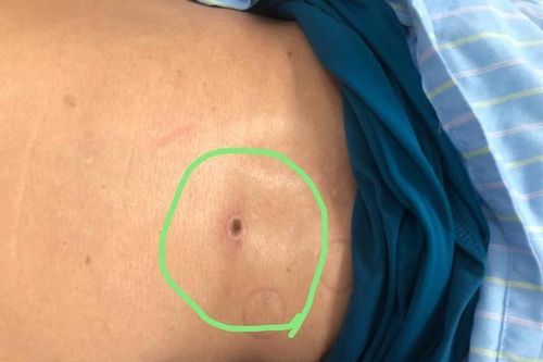 Bị mò đốt, người đàn ông suy đa tạng