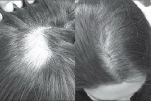 Uống thuốc tránh thai bị rụng tóc, vì sao?