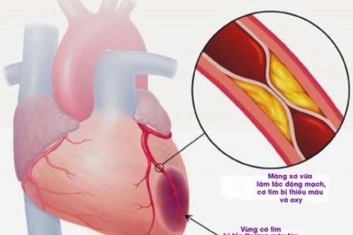 Ngay cả liều thấp steroid cũng có thể làm tăng nguy cơ mắc bệnh tim