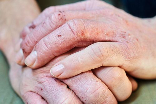 7 dấu hiệu trên bàn tay tiết lộ các vấn đề sức khỏe