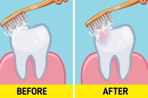 Nha sĩ bật mí thắc mắc nên đánh răng trước hay sau khi ăn sáng