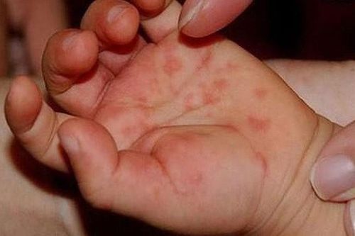 Các loại thuốc điều trị giảm nhẹ triệu chứng bệnh tay chân miệng