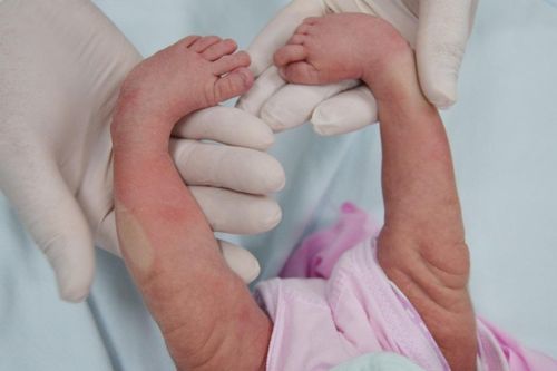 Con mắc dị tật do sai lầm của mẹ khi mang thai