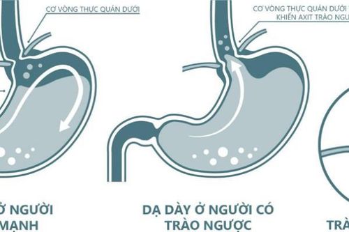 Vai trò của alginate và thuốc kháng axit trong điều trị trào ngược dạ dày