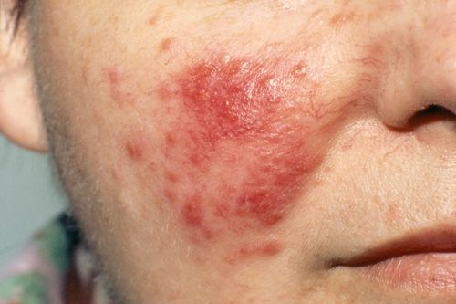 8 nguyên nhân khiến da nổi mẩn đỏ