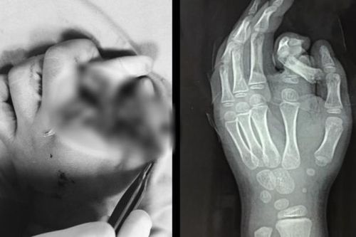 Ngón tay trẻ 6 tuổi đứt rời do cho tay vào máy giặt đang chạy