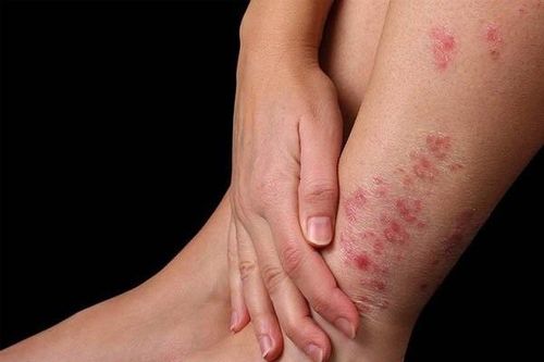 Các dạng viêm nhiễm da chân trong mùa mưa và cách phòng tránh