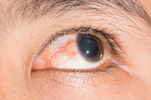 Tay chân miệng và sốt phát ban: Những dấu hiệu tương đồng dễ gây nhầm lẫn