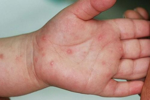 Hiện nay đã có thuốc điều trị bệnh tay chân miệng chưa?