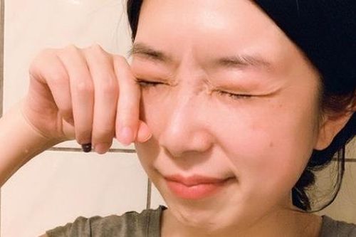 Cô gái đến khám trong tình trạng không thể mở mắt, bác sĩ cảnh báo do thói quen trang điểm mà nhiều chị em mắc phải