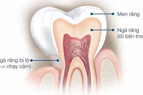 Phiền toái khi răng... nhạy cảm