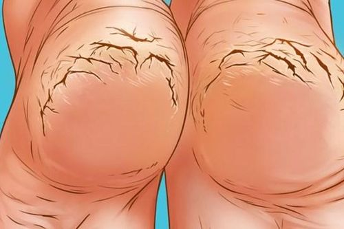 Điểm danh 6 nguyên nhân gây nứt gót chân và cách khắc phục đơn giản