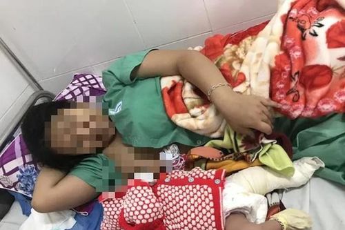 Bé trai sơ sinh bị gãy xương đùi sau sinh mổ
