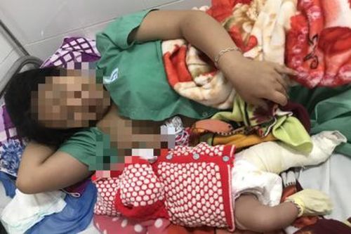 Một bé trai bị gãy xương đùi khi mổ sinh