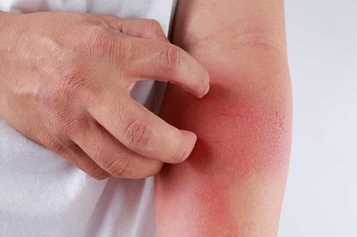 Nhận biết và kiểm soát viêm da tiếp xúc
