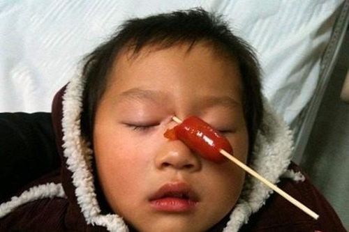 Chấn thương mắt ở trẻ em