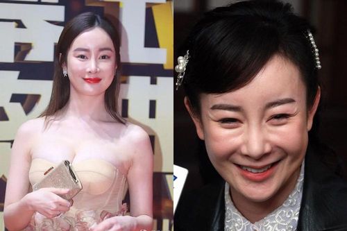 Bi kịch của những diễn viên phẫu thuật thẩm mỹ hỏng