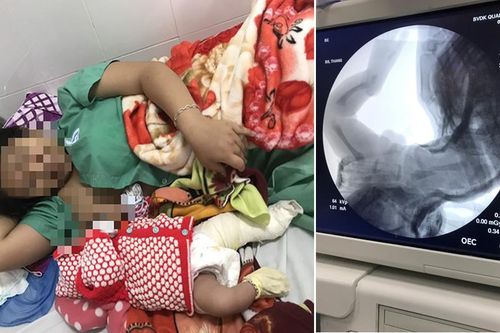 Bệnh viện Đa khoa Quảng Nam nói gì về việc bé trai gãy chân khi sinh mổ?