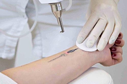 BS.CKII. Vũ Hữu Thịnh, Khoa Tạo hình thẩm mỹ BV Đại học Y Dược TP.HCM: 'Xóa xăm dễ để lại sẹo, cần cẩn trọng trước khi xăm'