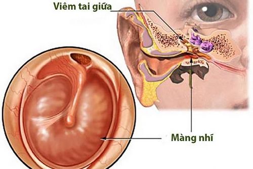 Bài thuốc trị viêm tai giữa