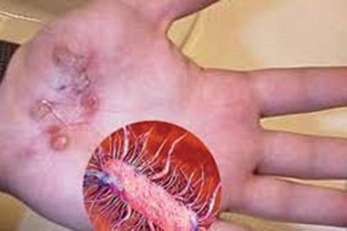 Nhận diện 'vi khuẩn ăn thịt người' từ lăng kính khoa học