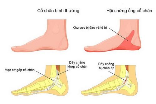 Chớ chủ quan với hội chứng đường hầm cổ chân