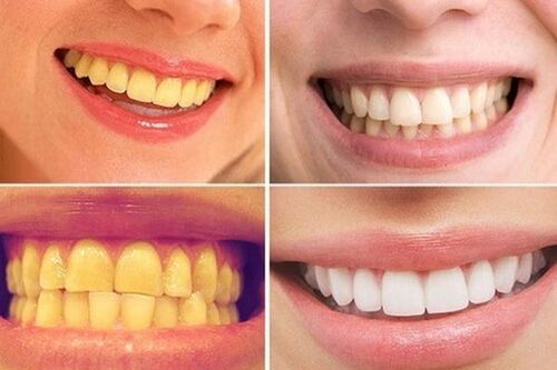 Khắc phục tình trạng răng nhuốm màu