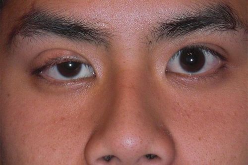 Căn bệnh chết người sau hiện tượng sụp mí mắt