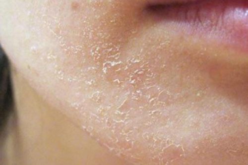 Thói quen khiến da bạn bị nứt nẻ