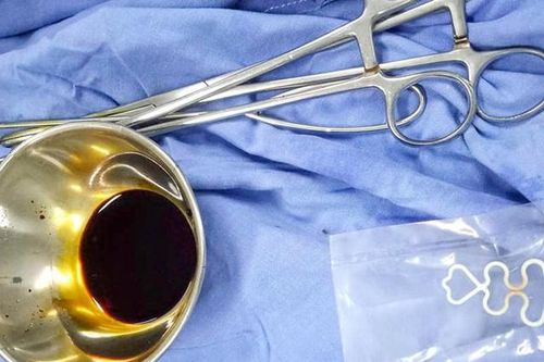 Vòng tránh thai nằm trong tử cung suốt 30 năm khi tháo ra vẫn còn nguyên vẹn
