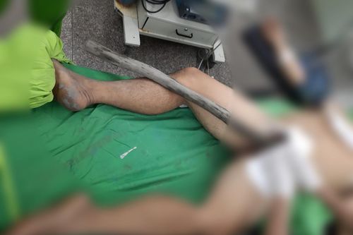 Cây gỗ dài 1,5m xuyên thẳng từ tầng sinh môn vào thành bụng người đàn ông