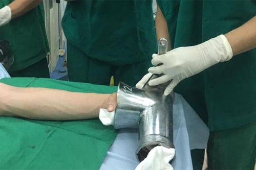 Cắt bỏ bàn tay do tai nạn lao động
