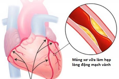 Tim mạch - bệnh lý gây tử vong số một trên thế giới