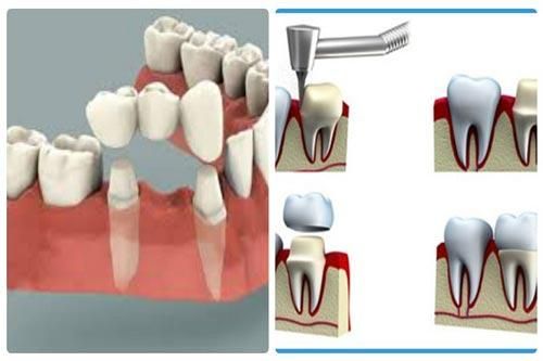 Bọc răng sứ - Đau đớn và những hiểm nguy chết người