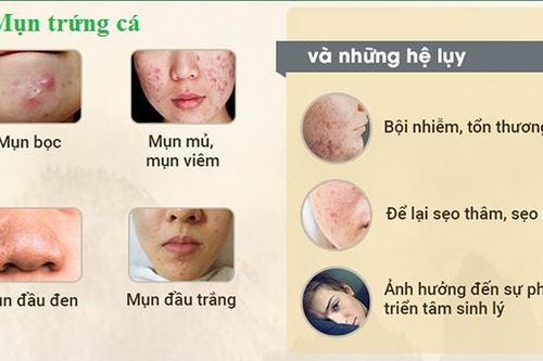 Cách hay để mụn trứng cá 'lặn tăm'