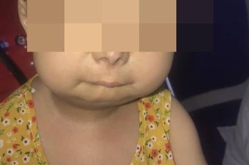 Cơ thể bé gái 6 tuổi lão hóa như người già