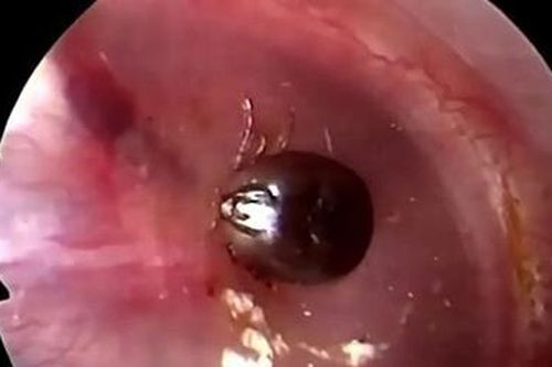 Bé gái 10 tuổi bị ve chó chui vào tai