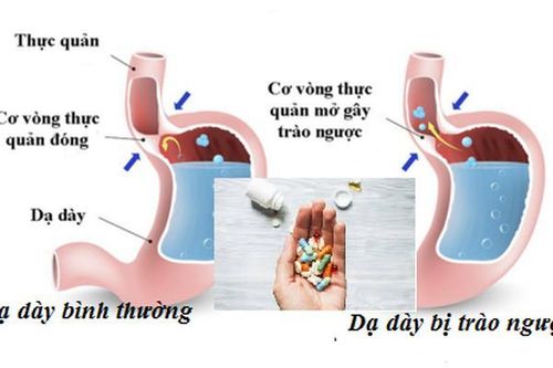 Thận trọng khi dùng ranitidine trị trào ngược dạ dày