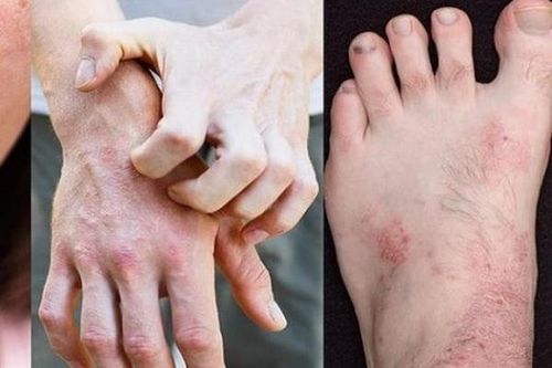Lựa chọn đúng thuốc trị viêm da cơ địa