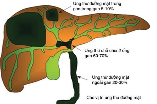 Vàng da có thể là một dấu hiệu của ung thư đường mật