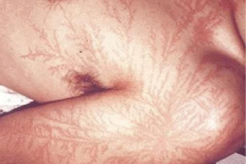 Bí ẩn những người bị sét đánh không chết mà lại trở nên 'siêu nhiên'