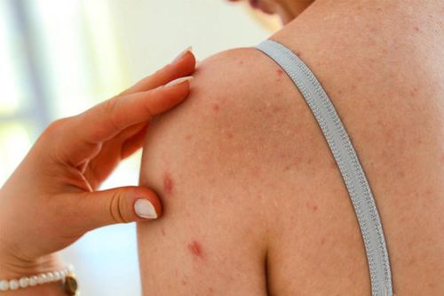 Vì sao cơ thể bạn ngày càng có nhiều mụn?