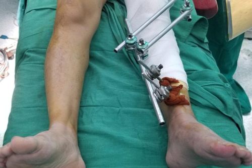 Bác sĩ ghép mảnh Titanium thay thế xương bị mất cho bệnh nhân
