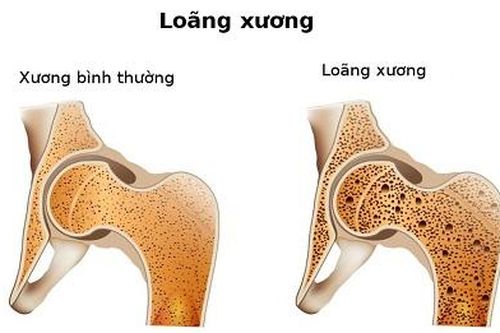 Có thể ngăn ngừa sự phân hủy xương do loãng xương